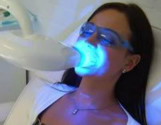 Professional Teeth Whiteninng Results At Home