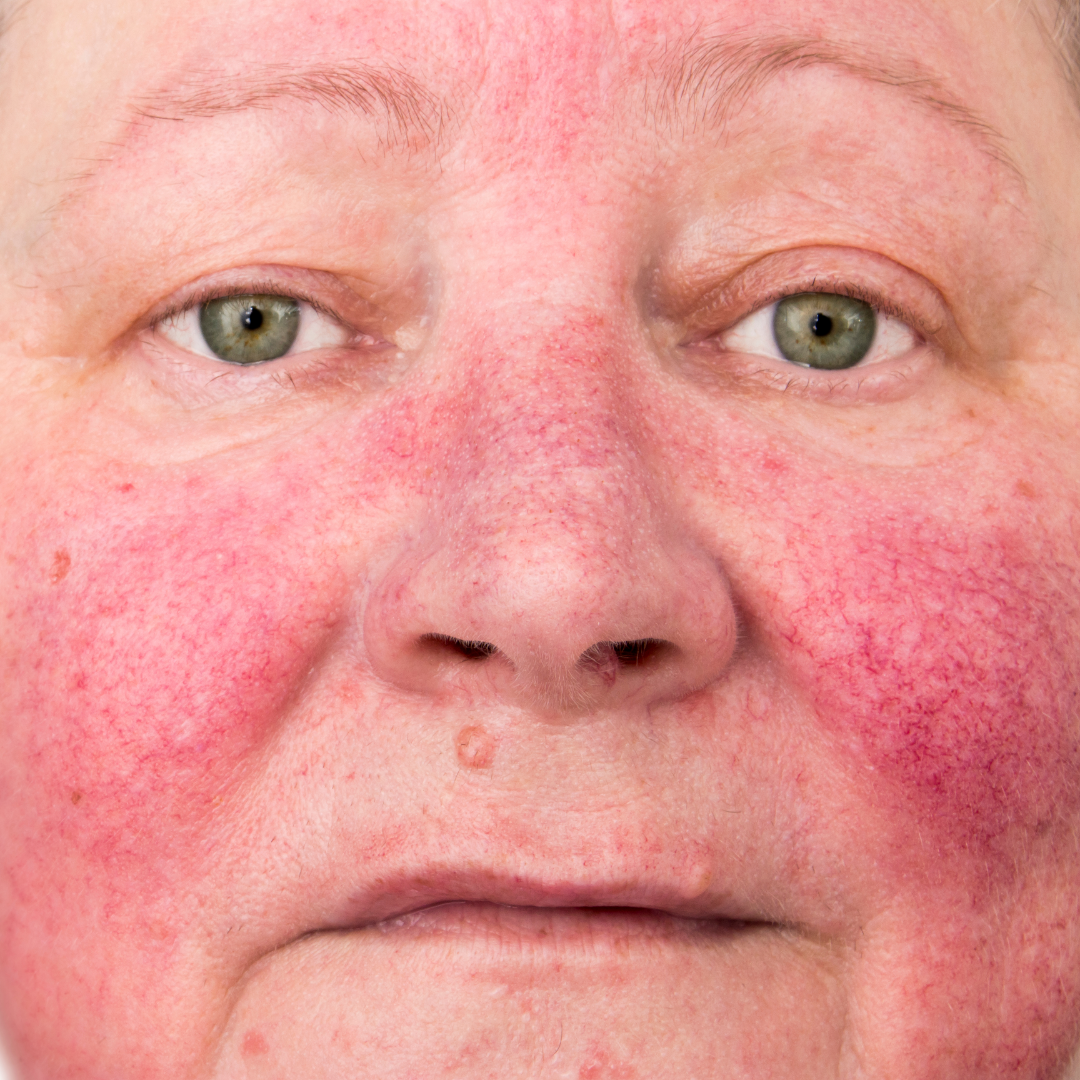 Rosacea with persistent redness, and it is the most common type. It can look like blushing or sunburn. This happens when flushing causes small blood vessels under your skin to become enlarged.